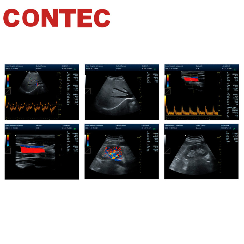 CONTEC Color Ultrasound Doppler Portable Ultrasound Machine CF/TDI CMS1700C