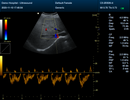 Color Doppler Portable Ultrasound Scanner Laptop Machine CMS1700A-VET with Rectal Probe